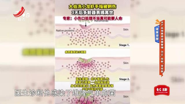 健康提醒：水产品细菌感染需警惕 勿让“抢鲜”变抢救