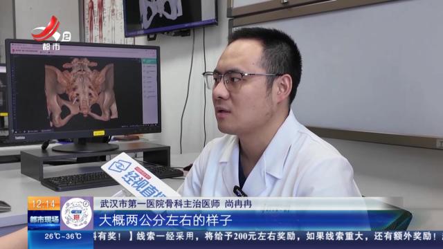 【放眼天下】湖北武汉：体温表在体内断裂 时隔22年彻底取出