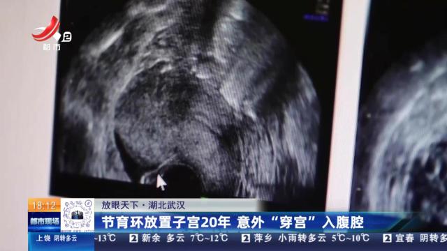 【放眼天下】湖北武汉：节育环放置子宫20年 意外“穿宫”入腹腔