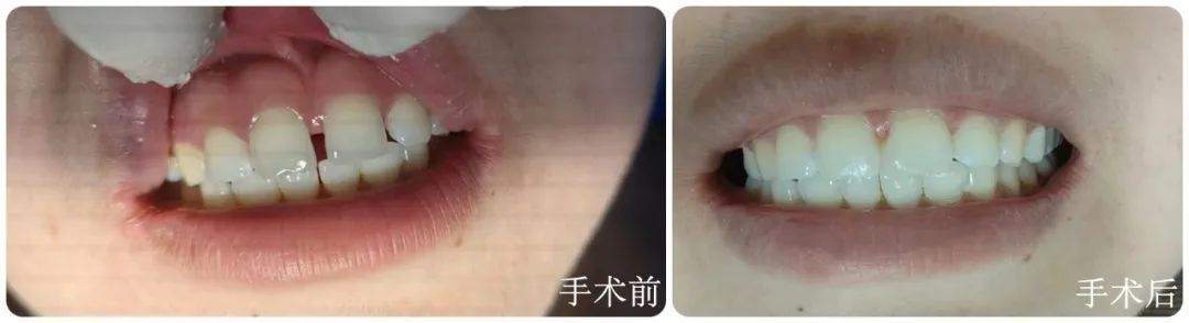 牙缝“合”好如初，九江市中医医院成功开展前牙美学树脂修复
