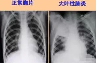 九江市妇幼保健院科普：宝宝咳不停、烧不退？别再误以为只是感冒，有可能是大叶性肺炎！