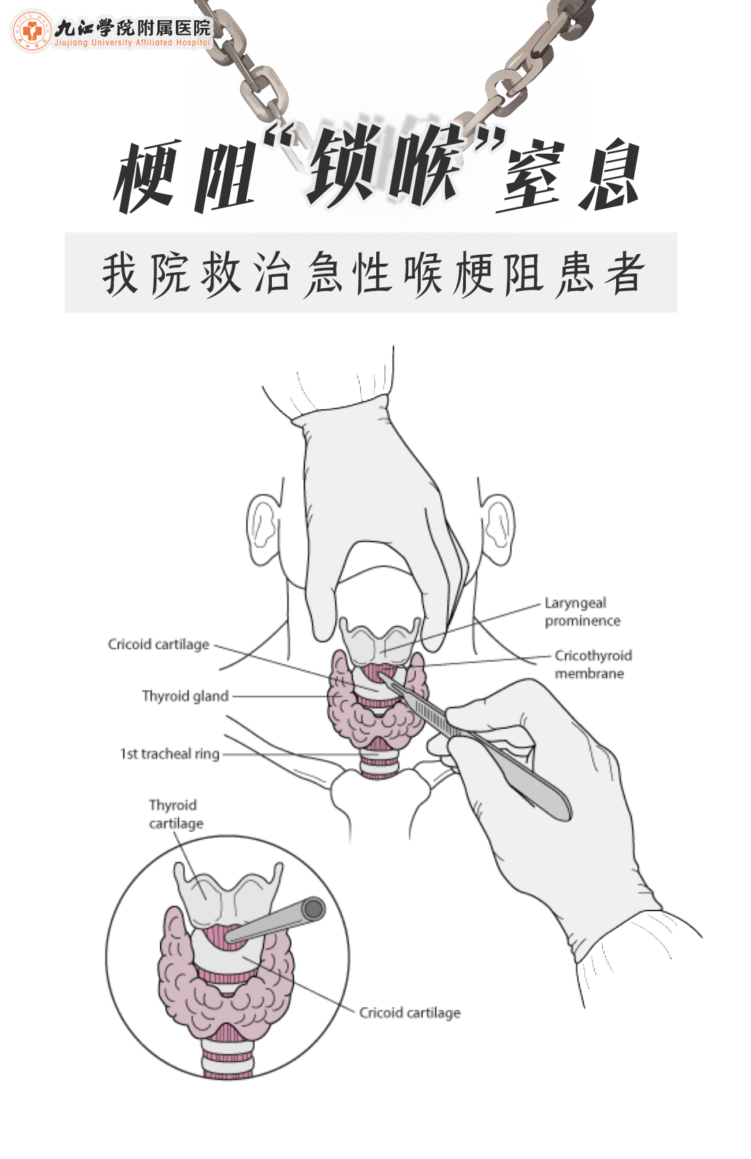 新闻科普 | 梗阻“锁喉”窒息 九江学院附属医院救治急性喉梗阻患者