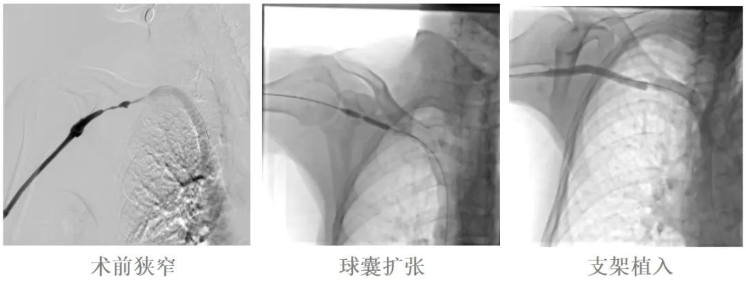 打通血透患者“生命线”！九江学院附属医院开展首例内瘘静脉支架植入术