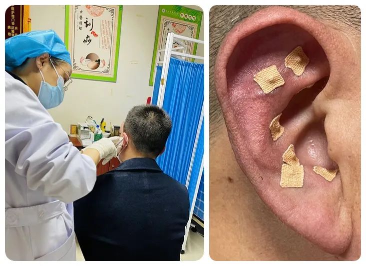 九江市中医医院运用耳穴疗法成功改善患者急性腰痛