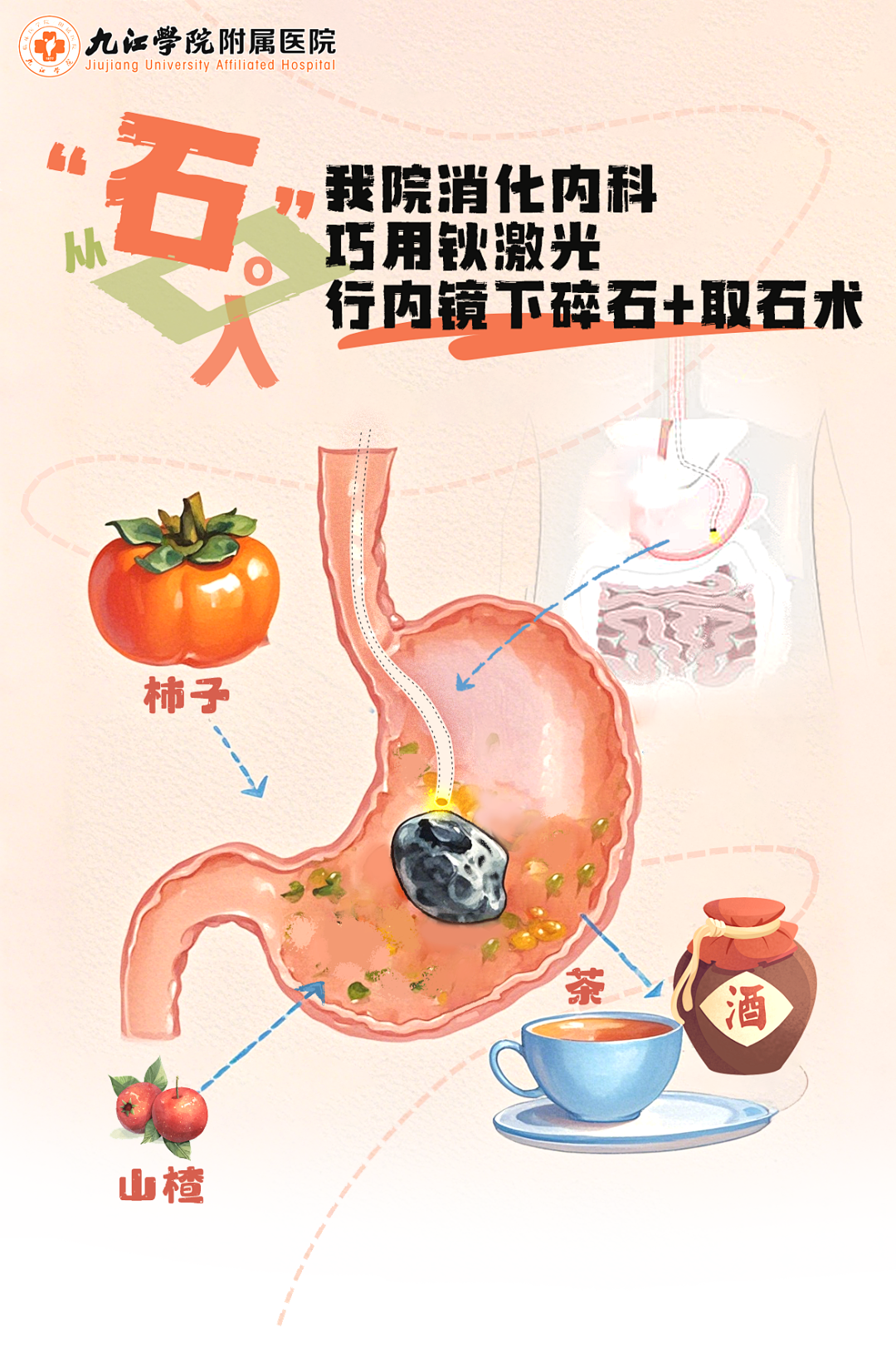 大量食用柿子致巨大胃结石，九江学院附属医院巧用钬激光为患者胃镜取石
