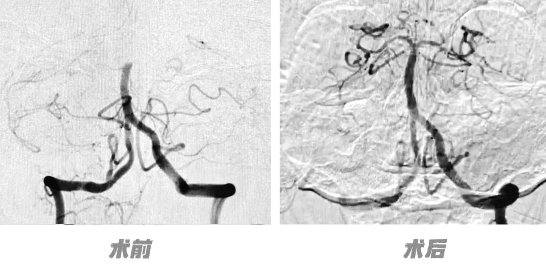 突发脑梗死，九江学院附属医院为98岁高龄患者成功实施取栓手术