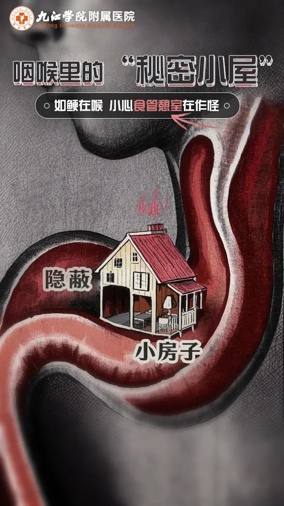 九江学院附属医院：总感觉“如鲠在喉”？可能是食管憩室在作怪