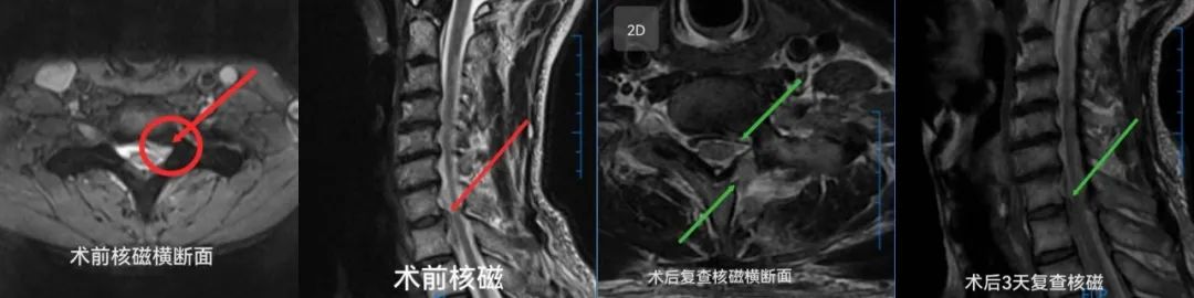 九江市骨科医院运用内镜下颈椎后路微创手术治疗神经根型颈椎病