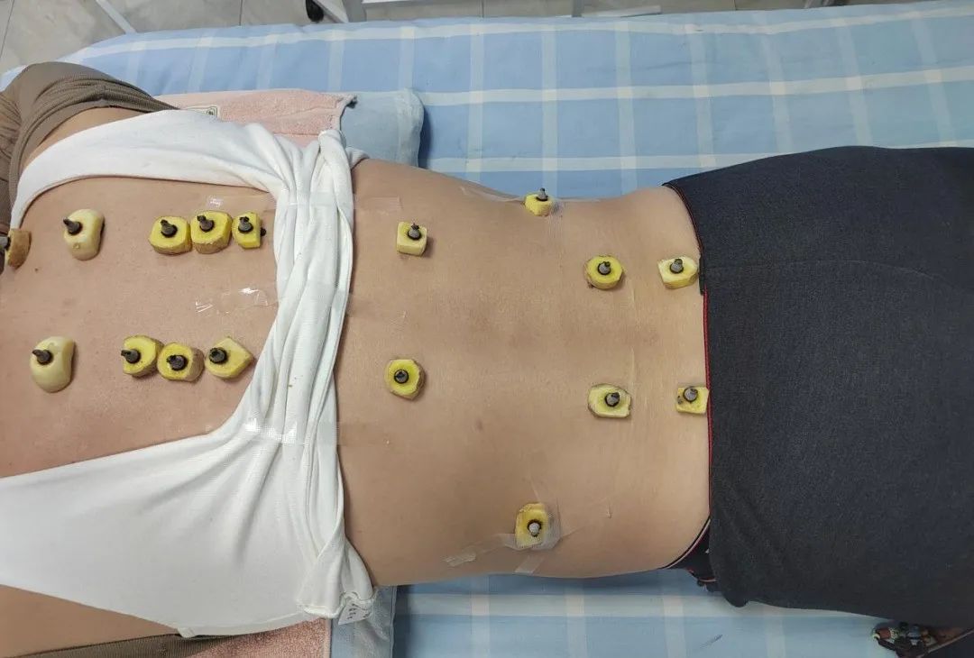 调理失眠“有良方”，九江市中医医院运用聚能艾塔立体隔物灸治疗失眠