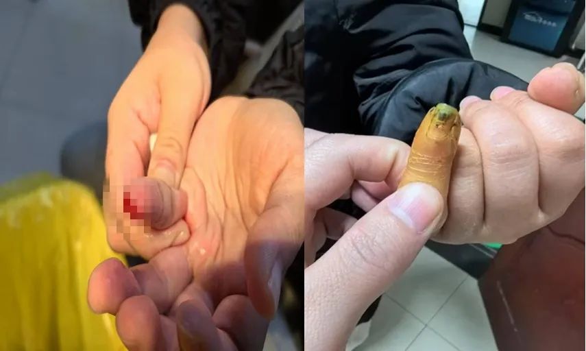 九江市中医医院运用中西结合成功治疗手指末节不全离断伤