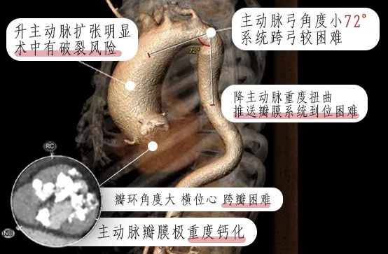 微创换“心门” ！九江学院附属医院独立完成一例高难度经皮主动脉瓣置换术（TAVR）