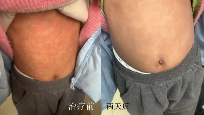 小儿发烧不用慌，九江市中医医院辨证施治儿童突然发热性出疹