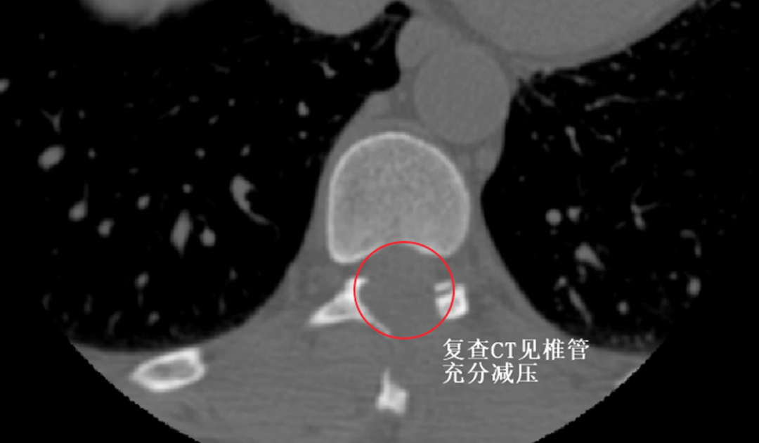 胸椎压迫险瘫痪，九江学院附属医院为患者行高难度OSE下胸椎黄韧带骨化切除术