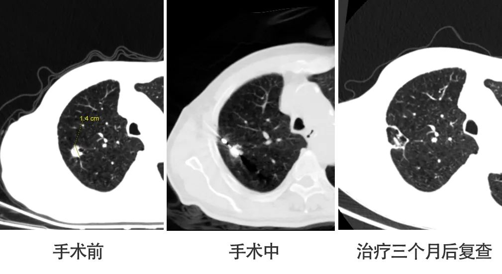 以“针”代“刀”！九江学院附属医院开展CT引导下经皮肺结节微波消融术