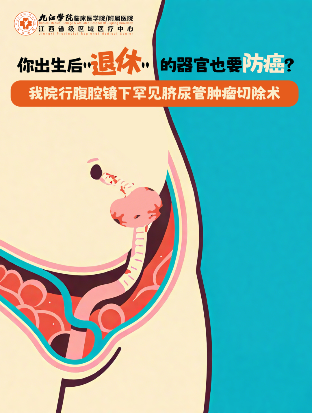 你出生后"退休"的器官也要防癌？ 九江学院附属医院行腹腔镜下罕见脐尿管肿瘤切除术
