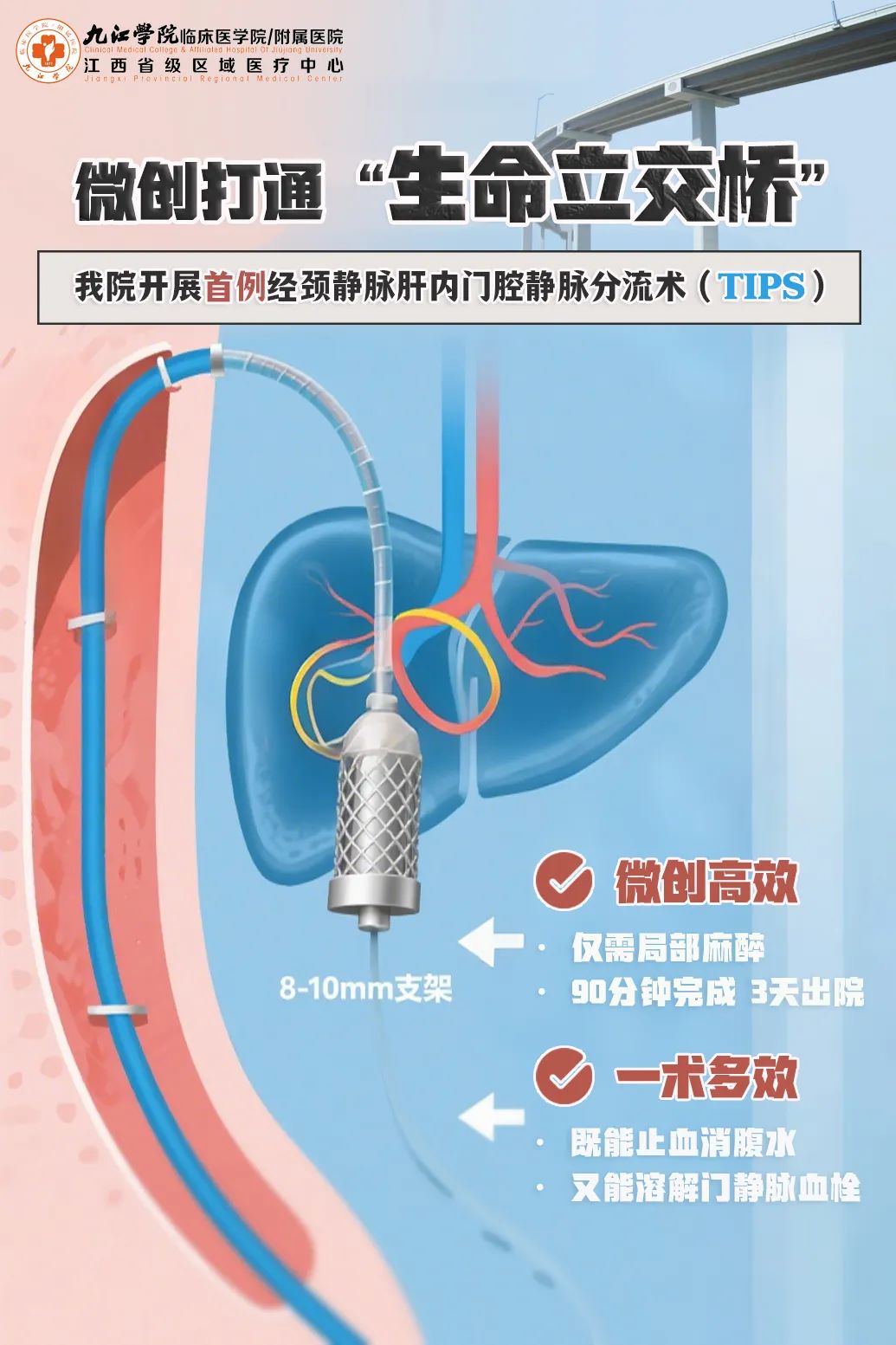 九江学院附属医院开展首例经颈静脉肝内门腔静脉分流术（TIPS）