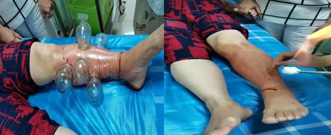 火针一点红肿即散，九江市中医医院运用中医辨证施成功治疗丹毒
