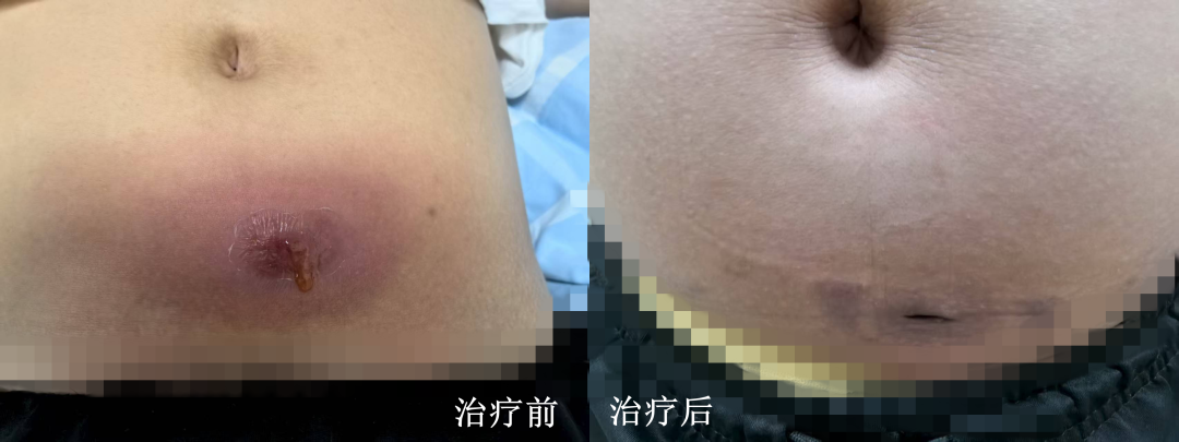 九江市中医医院运用中西医结合治疗顽固腹部皮肤脓肿